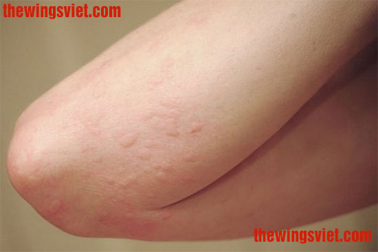 yến sào có gây dị ứng không yến sào có gây dị ứng không