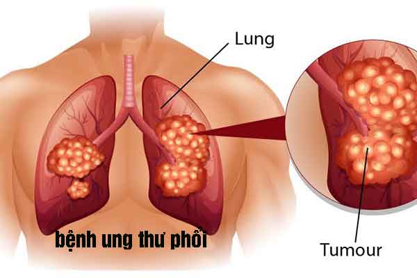 bệnh ung thư phổi